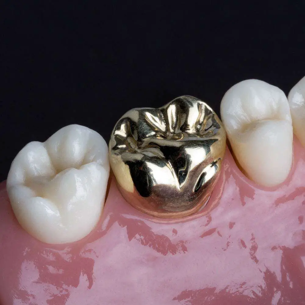 A Brief History of Dental Crowns