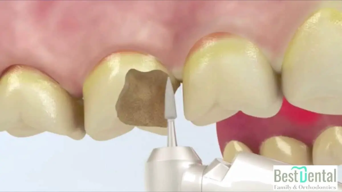 Dental Crowns in Humble, TX