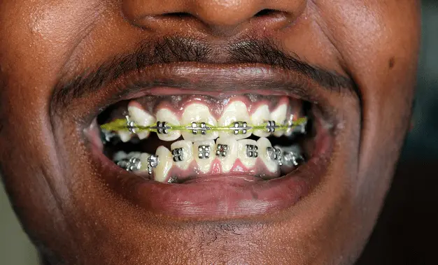 How Much Are Braces.m
