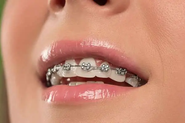 How much do braces cost in india?