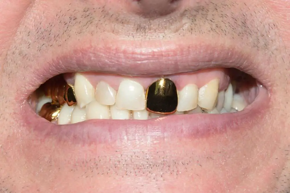 How much does a gold tooth implant cost ...