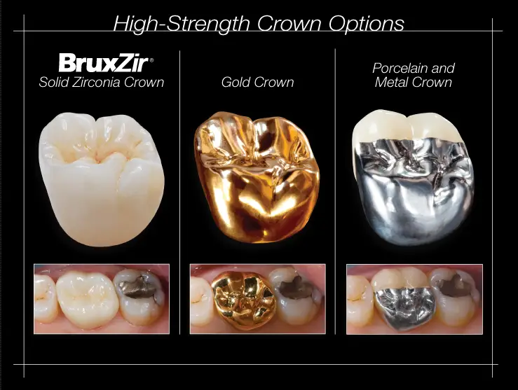 Should you get an all ceramic or gold crown?