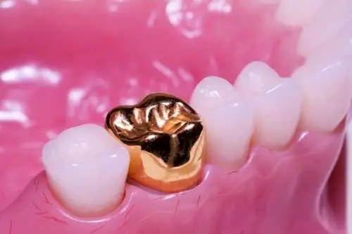 What Are Dental Crowns Made of and Why Are They Valuable?